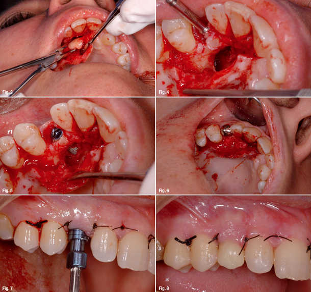 What You Should Know About Teeth Extraction. | Etcetera9ja